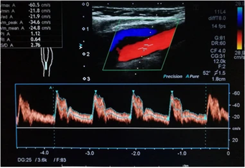 Colour Doppler Ultrasound in Chandigarh
